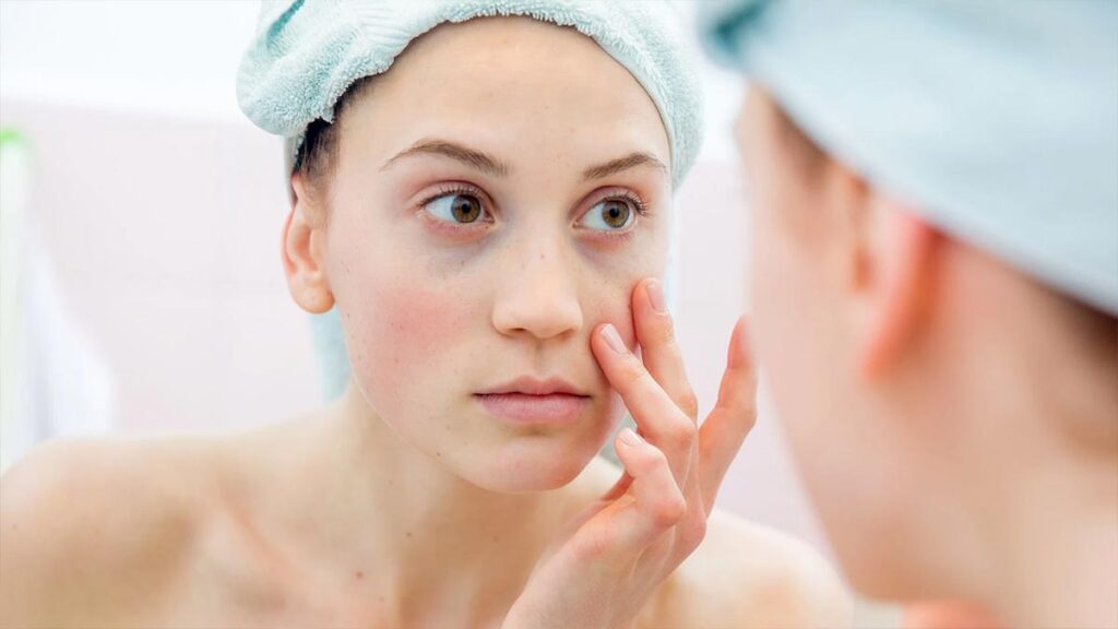 causes of dark circles under the eyes